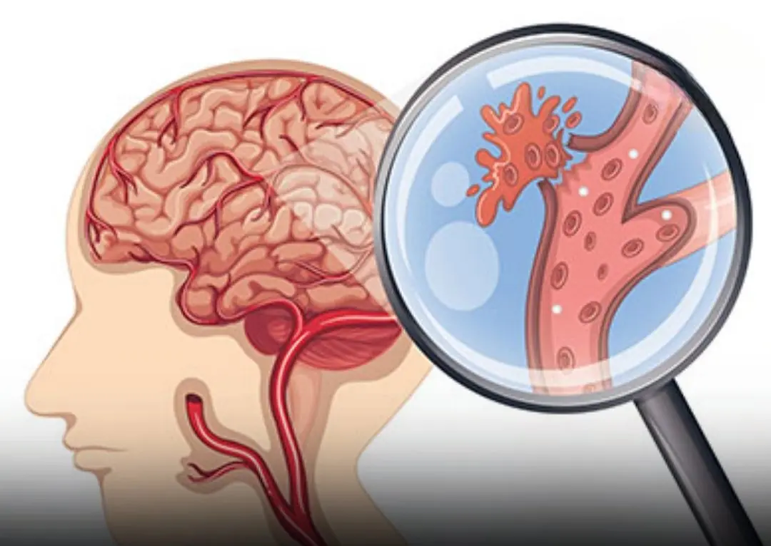 Recognizing an Aneurysm: The Dang:erous Symptoms That Demand Immediate Attention