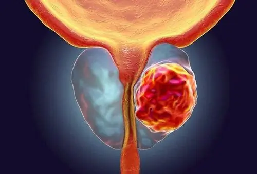 5 Red Flags of Bladder Cancer Most People Miss