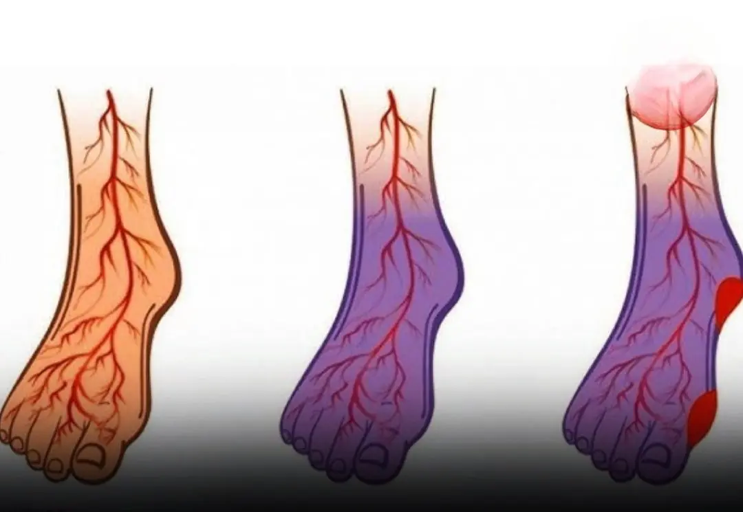 High Blo:od Pressure, Stroke, or Varicose Veins? These 5 Things Can Make a Big Difference