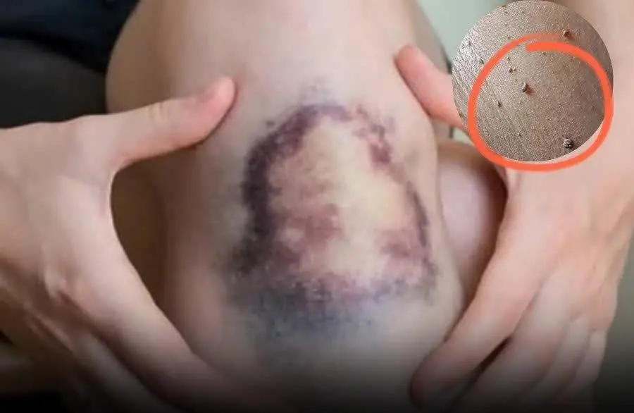 4 skin signs that silently reveal cancer is growing inside — check yours now.