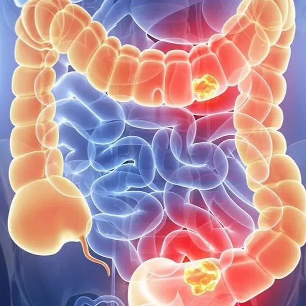 Woman Diagnosed with Stage Four Colon Cancer Warns Others: 5 Symptoms She Ignored