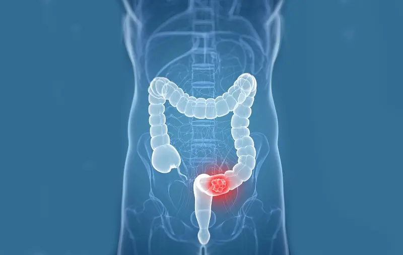 Don’t Miss These 6 Early Warning Symptoms of Stage 1 Colon Can.cer