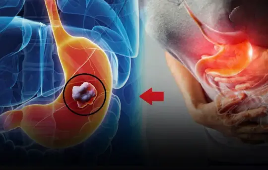 7 Silent Symptoms Showing Your Stomach Can:cer May Be in Its Final Stages