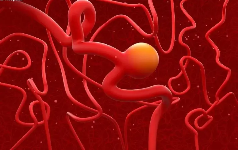 Symptoms That May Indicate an Aneu.rysm