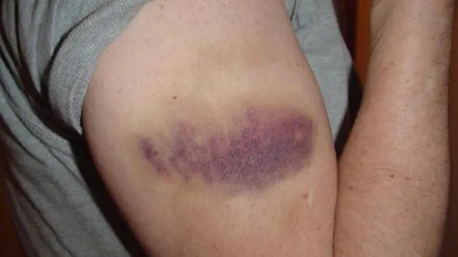 Why Do Random Bruises Appear on Your Body and Legs?