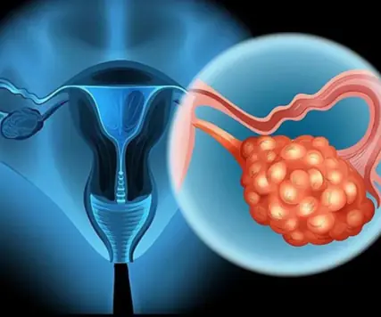 8 Early Warning Signs Of Ovarian Cancer You Shouldn’t Ignore
