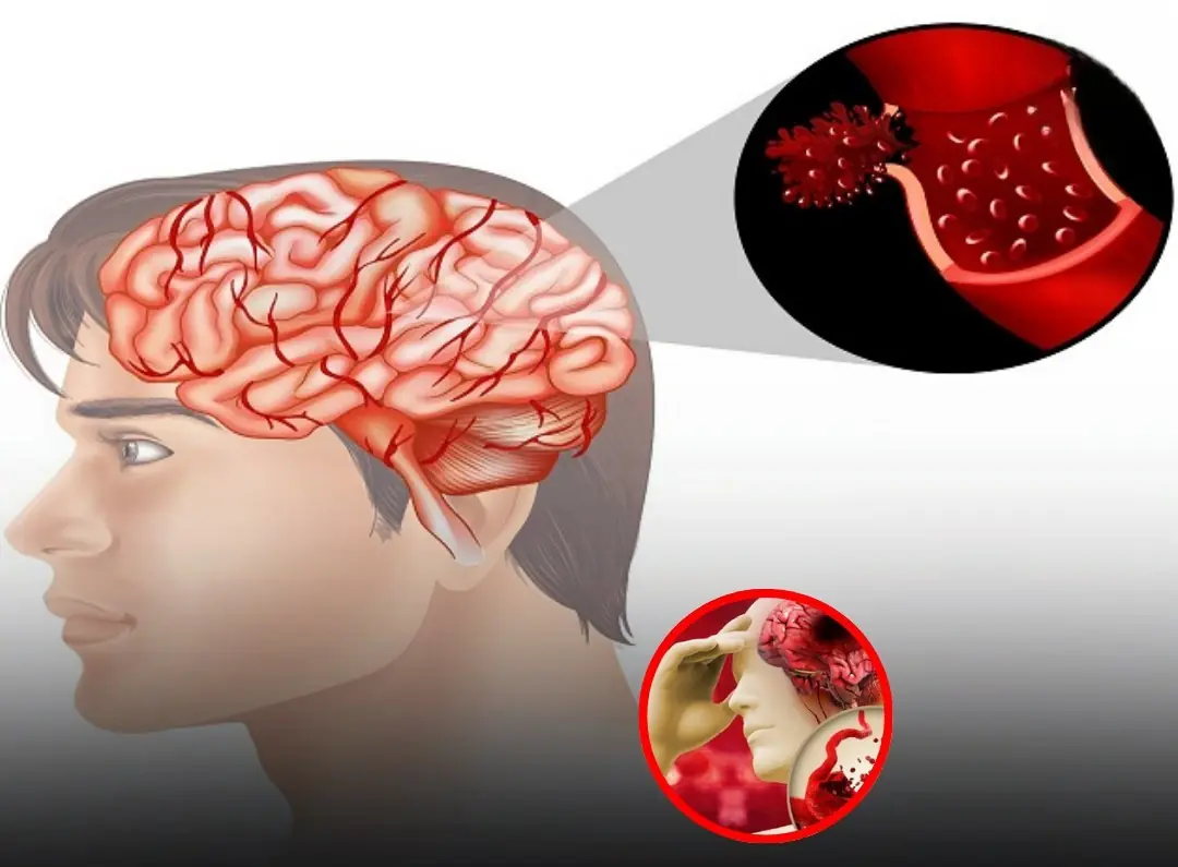 Avoid These 4 Risky Morning Habits That May Contribute to Str:oke