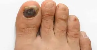 What Causes a Toenail to Turn Black? Understanding the Warning Signs