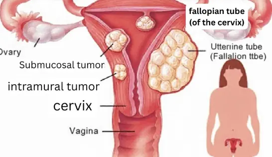 Typical signs of uterine fibroids