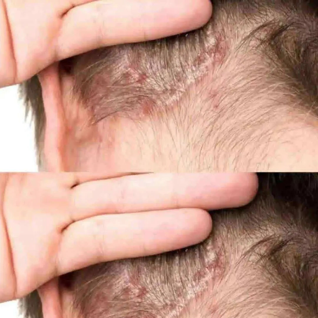 Found something unusual on my son’s scalp and I’m a bit worried. Since we can’t see a doctor right now, any suggestions?