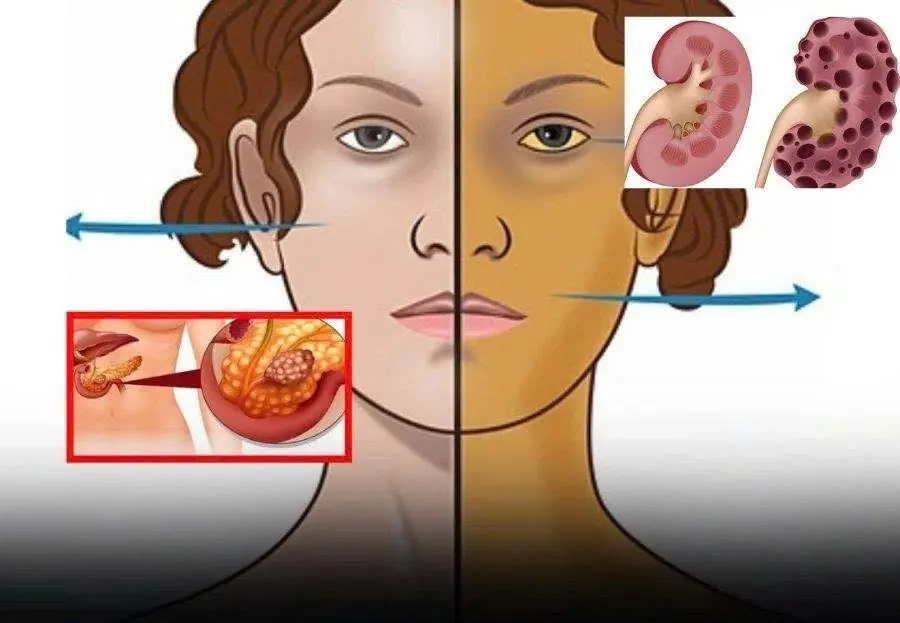 Spot Pancreatic Ca:ncer Early – 11 Warning Signs You Shouldn’t Ignore
