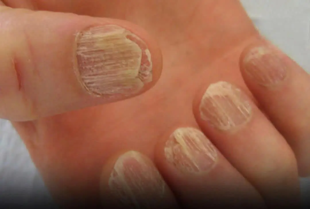 9 Alarming Nail Changes That Reveal Hidden Health Problems — Watch for White Nails and Black Borders