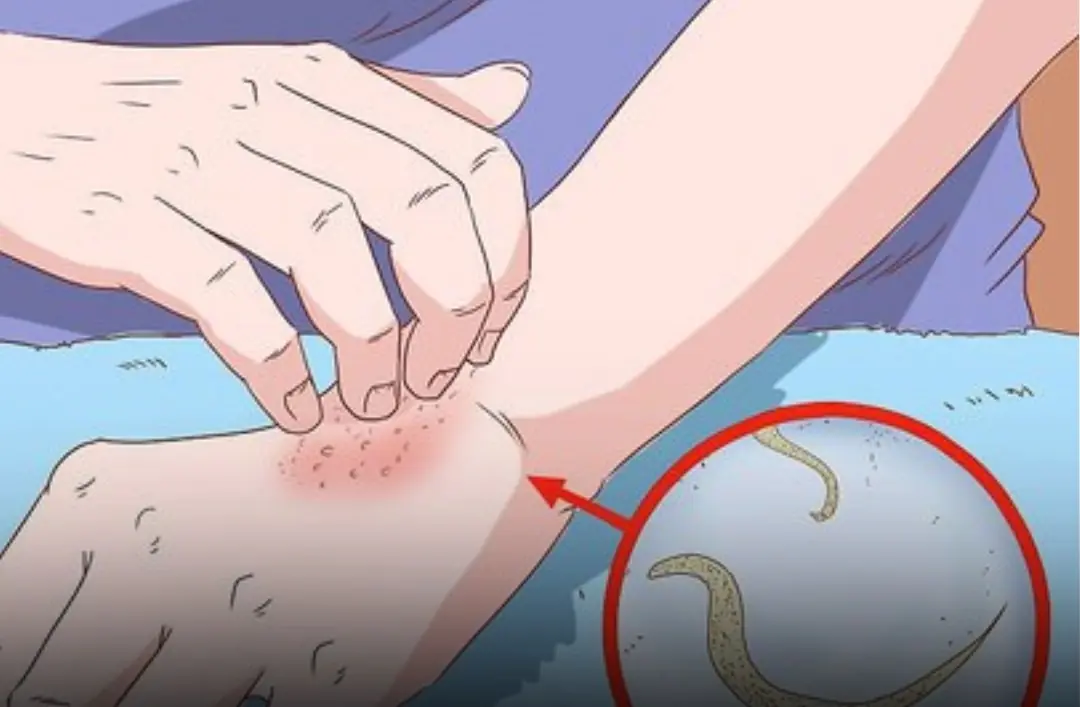 Warning Signs of Pinworm Infection You Should Never Ignore—and How to Prevent It