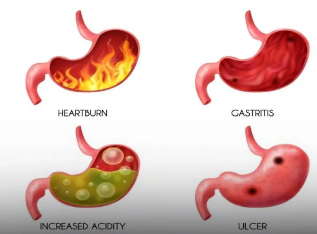 9 Proven Natural Ways to Manage Acid Reflux at Home