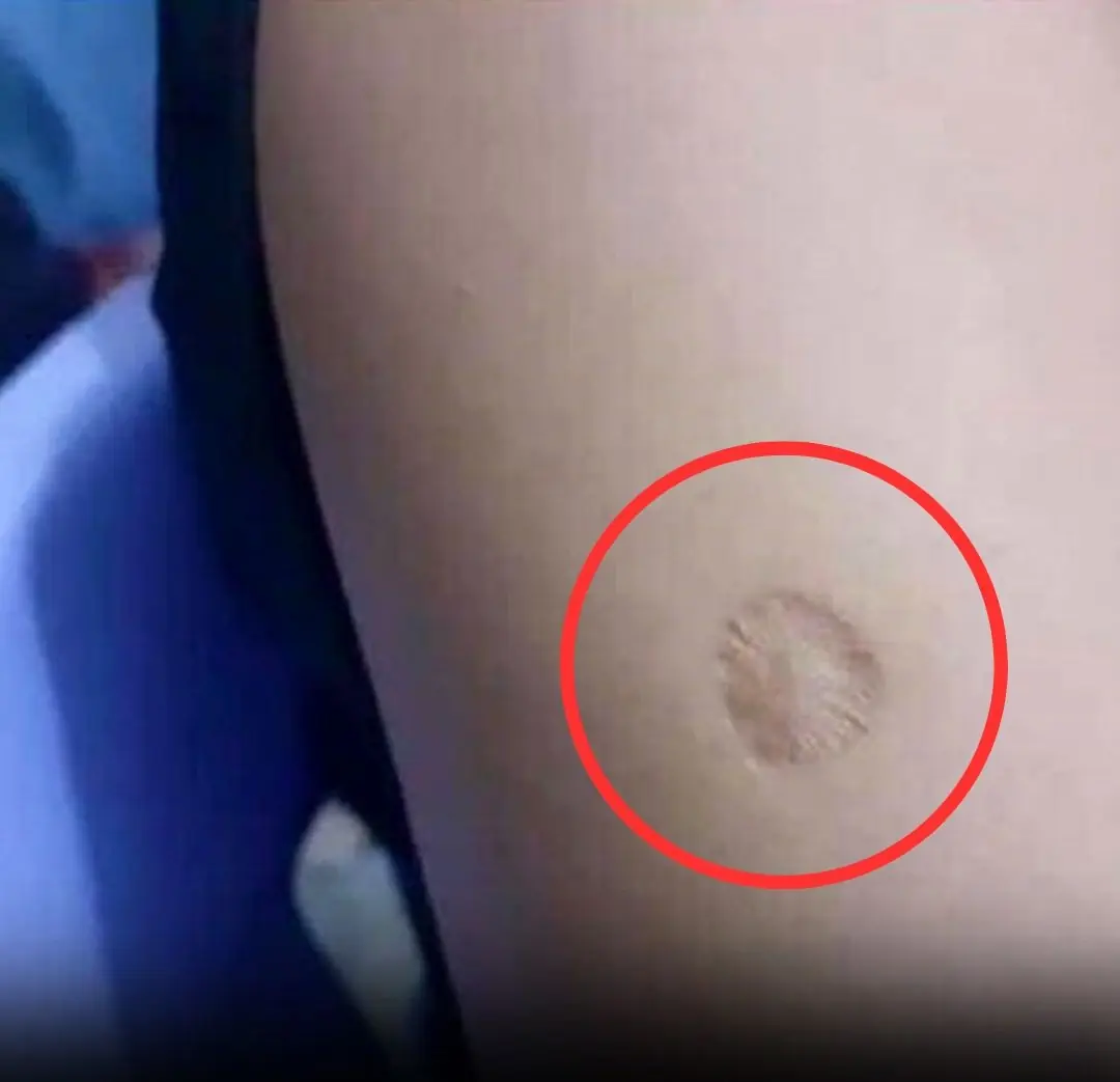 The Small Round Scar on Your Arm …What It Really Means