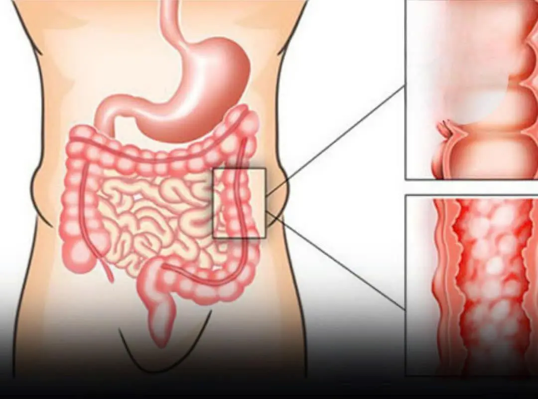 6 Silent Warning Signs of Early-Stage Colon Cancer You Shouldn’t Ignore