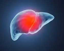 Advanced Liver Cancer: What Symptoms to Watch For