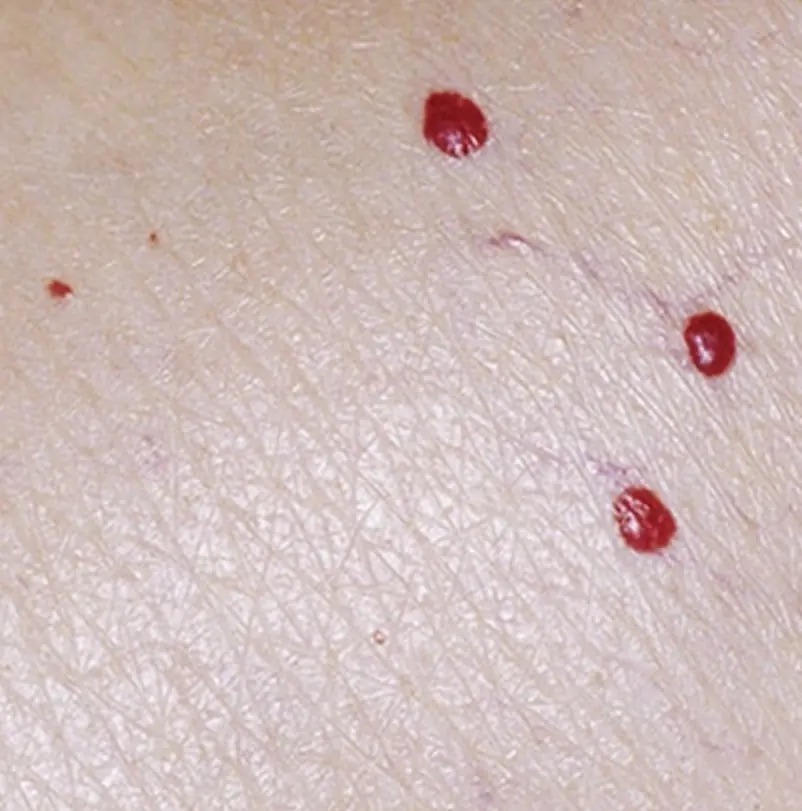 If You’ve Ever Noticed Red Spots on Your Body, Here’s What They Might Mean