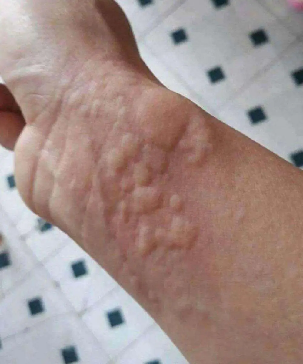 The Silent Dan.ger on Your Skin: Why Hives with Breathing Issues Should Never Be Ignored