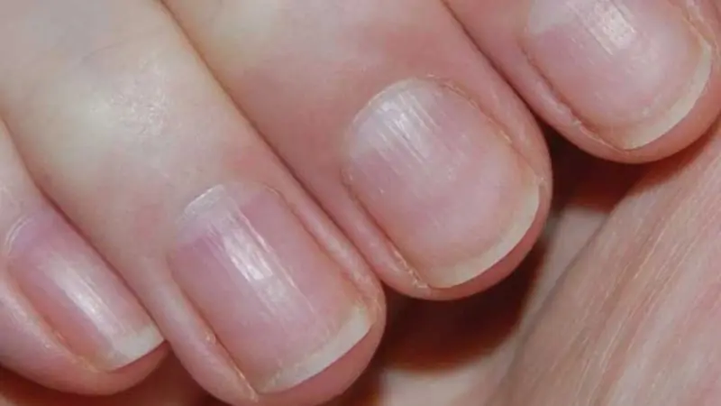 Doctors highlight 8 possible health problems that can be detected through your nails