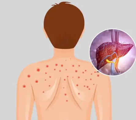 Fatty Liver: Causes, Symptoms, Treatment & Home Remedies