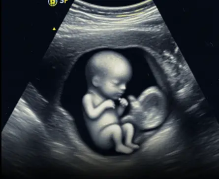 Scientists May Have Actually Found One Of The Causes Of Autism