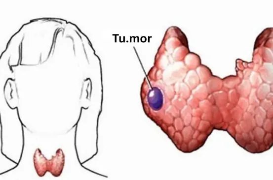 Who is at high risk for thyroid can:cer?