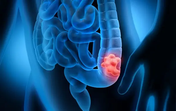The rate of colon can.cer is on the rise—discover the 5 warning signs you shouldn’t ignore.
