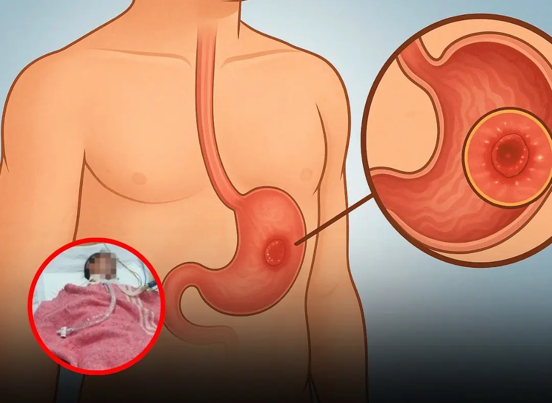 Doctor Highlights 3 Bedtime Habits That Could Affect Stomach Health After Woman’s Can:cer Case