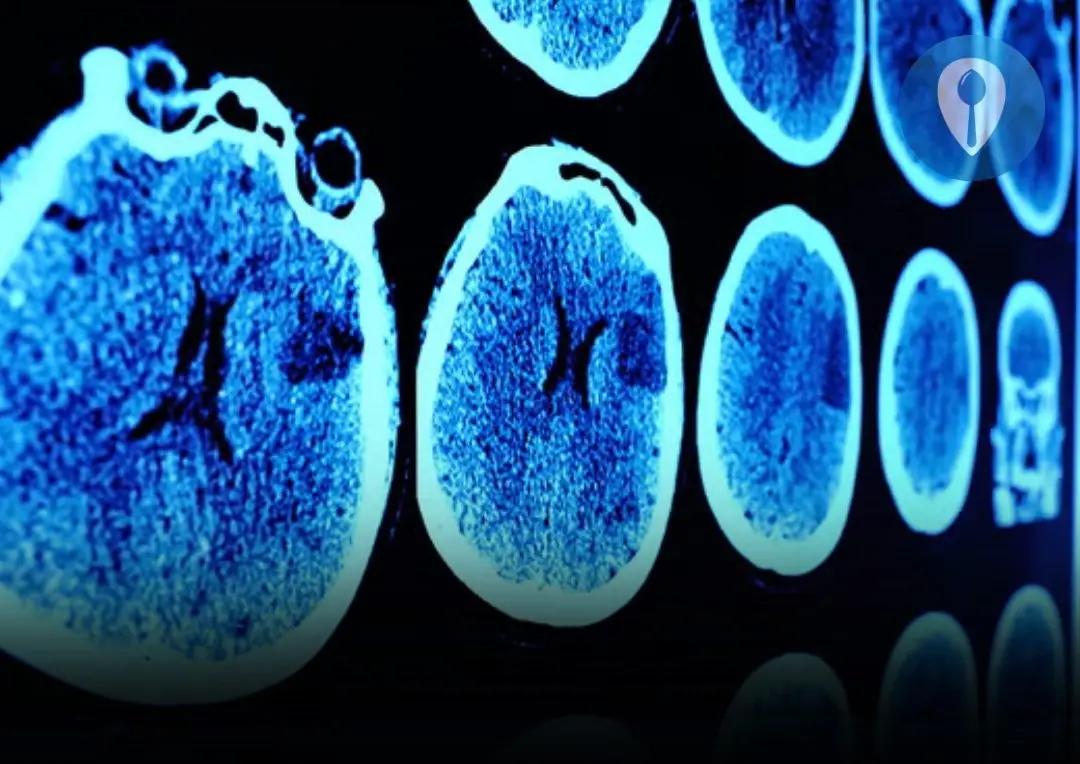 7 Possible Brain Can:cer Symptoms Every Woman Should Be Aware Of