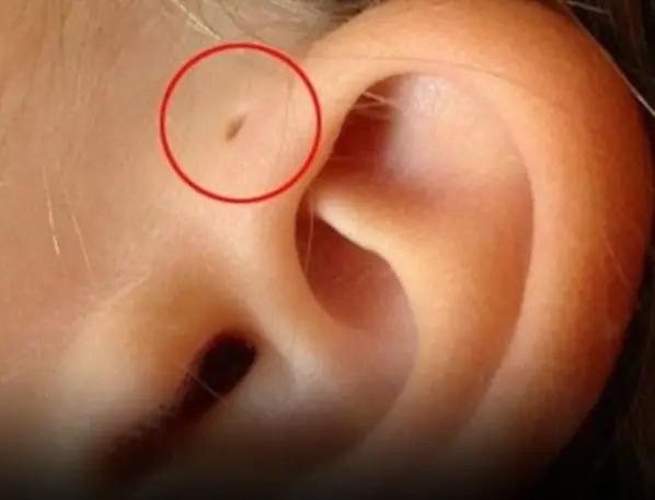 The Hidden Meaning of That Tiny Hole on Your Ear