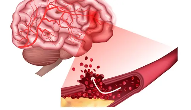 Silent strokes often go unnoticed, but these small daily habits could protect your brain