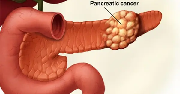 Early detection of pancreatic can.cer is crucial: know the warning signs and symptoms