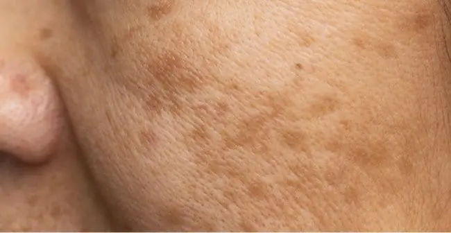The truth about age spots: when they’re harmless and when to see a doctor