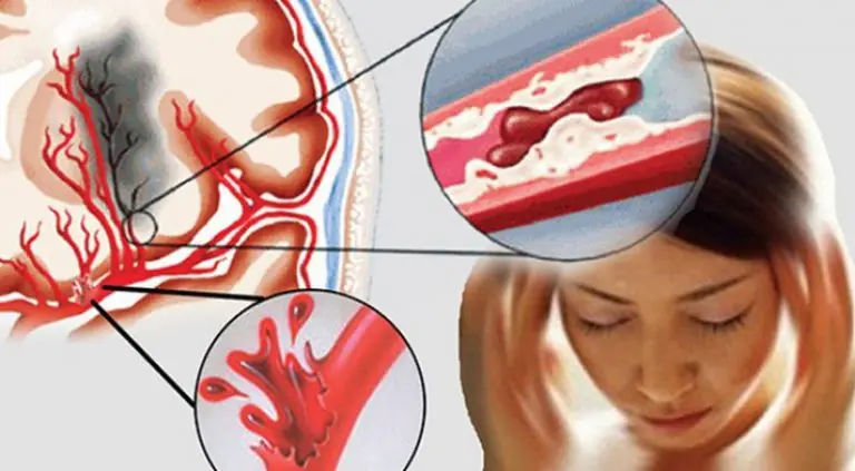 7 situations that may increase the likelihood of a brain hemo.rrhage