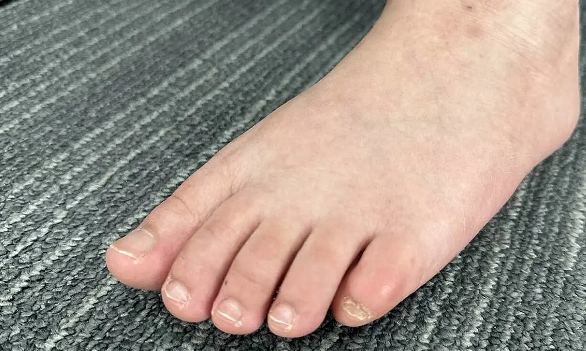 This foot symptom could be a sign of advanced fatty liver dis.ease you shouldn’t ignore