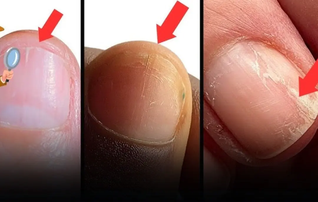 Do Your Nails Keep Breaking or Splitting? It Could Be a Warning Sign From Your Body.