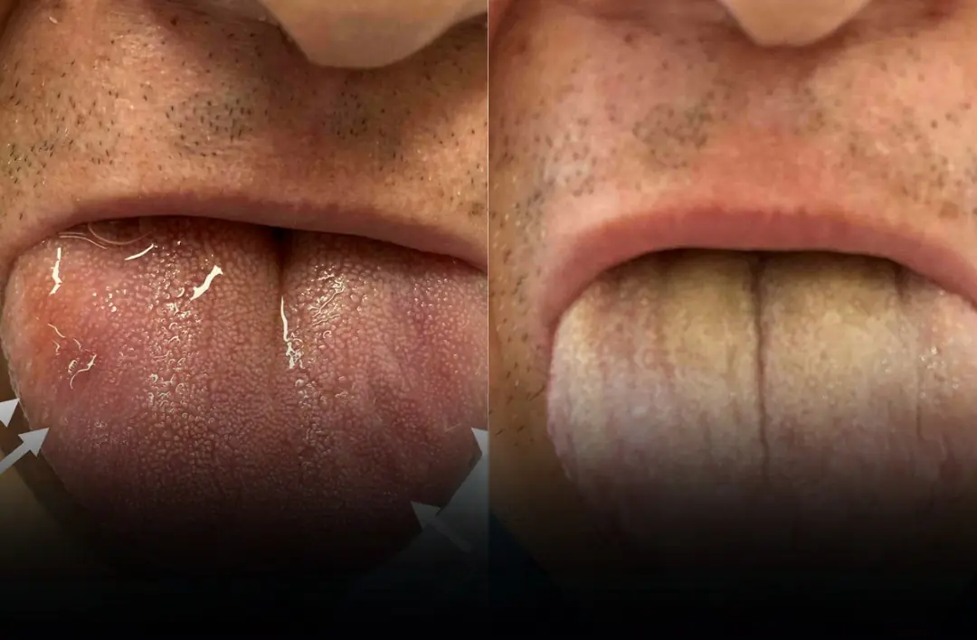 What a Scalloped Tongue Might Be Telling You About Your Health