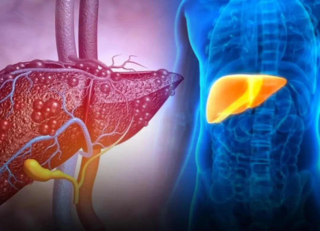 If You Experience These Symptoms, Your Liver Health May Be at Risk