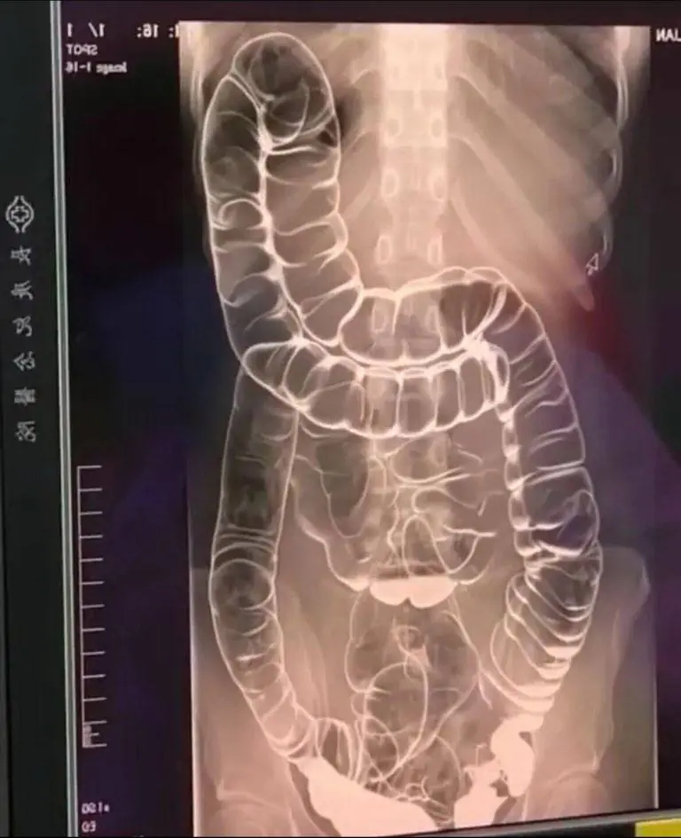 A Shocking X-Ray After Weeks of Constipation Leaves Many Concerned