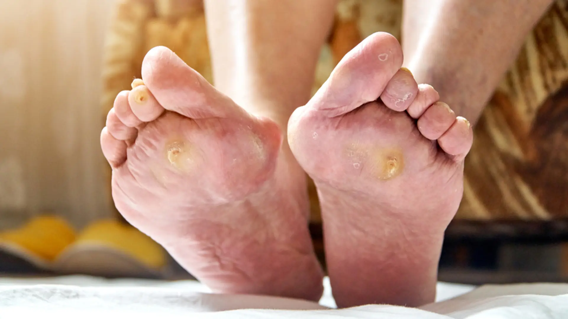 Plantar Warts on Your Feet: Why They’re Often Mistaken for Calluses