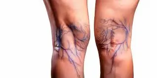 High Blood Pressure, Stroke, or Varicose Veins? Try These 5 Life-Changing Habits