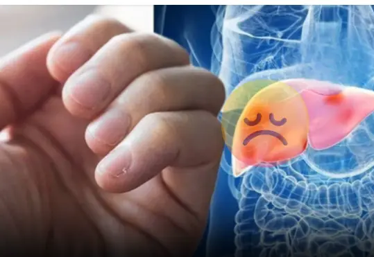 People with liver failure often have 3 characteristics on their hands, if you have 1 you should see a doctor soon
