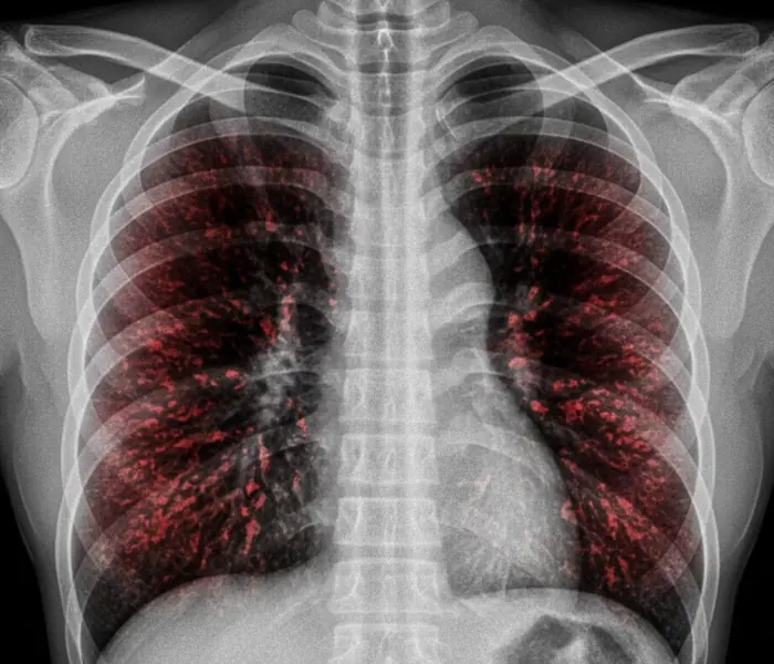 Why Lung Can.cer Cases Are Rising in People Who Have Never Smoked?