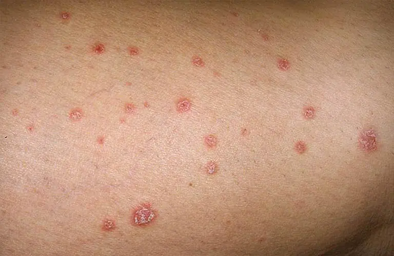 Why Do Red Spots Appear on Your Skin? Causes and What They Could Signal