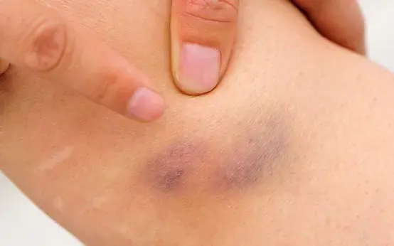 Don’t Ignore These Bruises — Here’s What They Could Mean