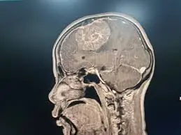 Silent Signals Your Body Sends: Key Warning Signs of an Aneurysm You Should Never Ignore