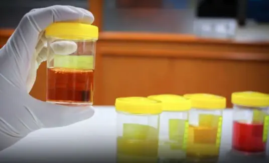 U.r.i.ne color and smell reveal your health, especially your l.i.ver and k.i.dneys