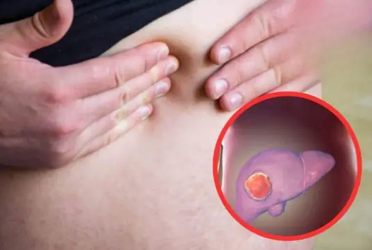 Big Belly Doesn’t Always Mean Fat: How to Distinguish Between Belly Fat and Liver Disease