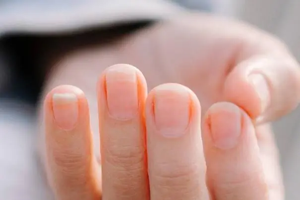 Check your nails: signs that could indicate health concerns